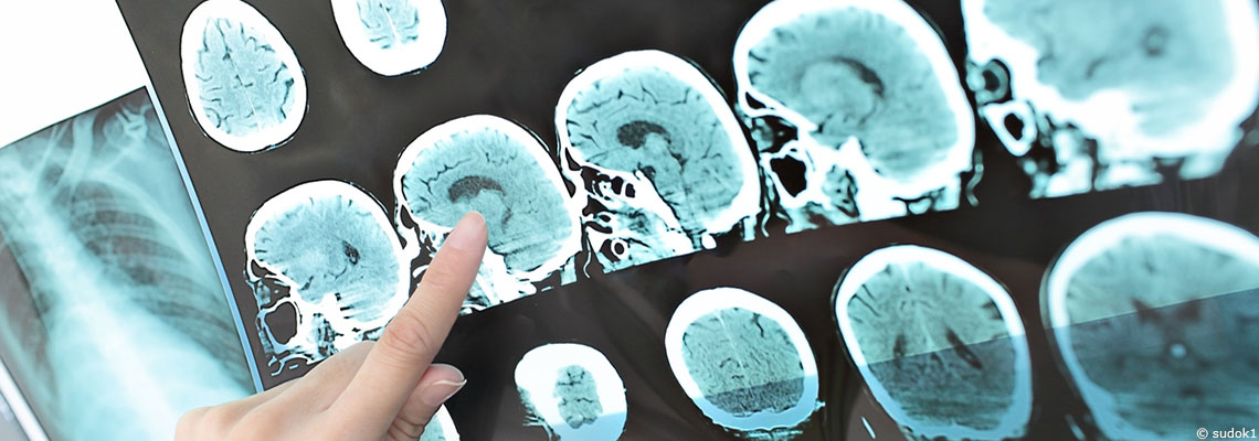 Maladies neurodégénératives et aromathérapie