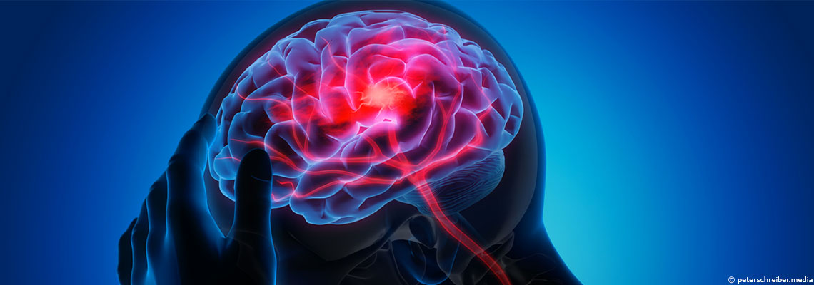 Les personnes de ce groupe sanguin auraient plus de risques d'avoir un AVC que les autres