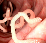 Parasites : des troubles pas toujours faciles à diagnostiquer